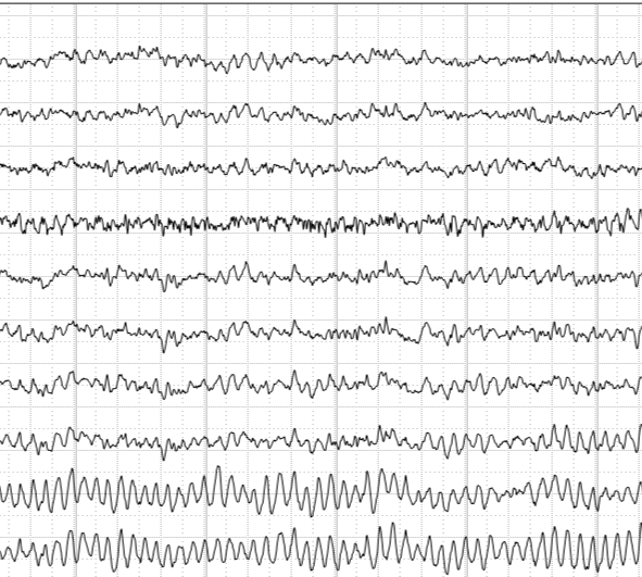 dr dechaumont palacin - Electroencéphalographie EEG